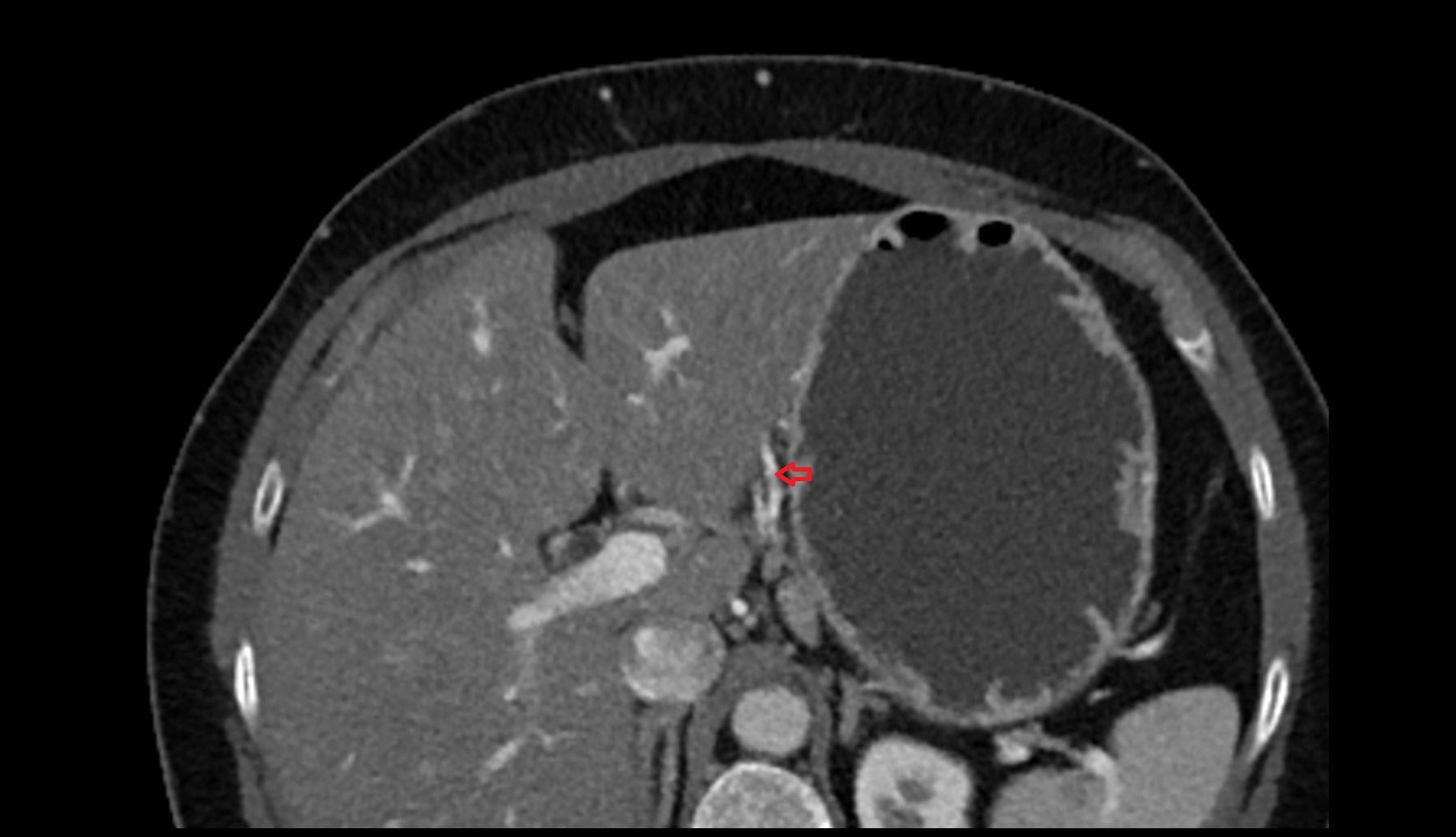 Right gastric vein CT axial image 3