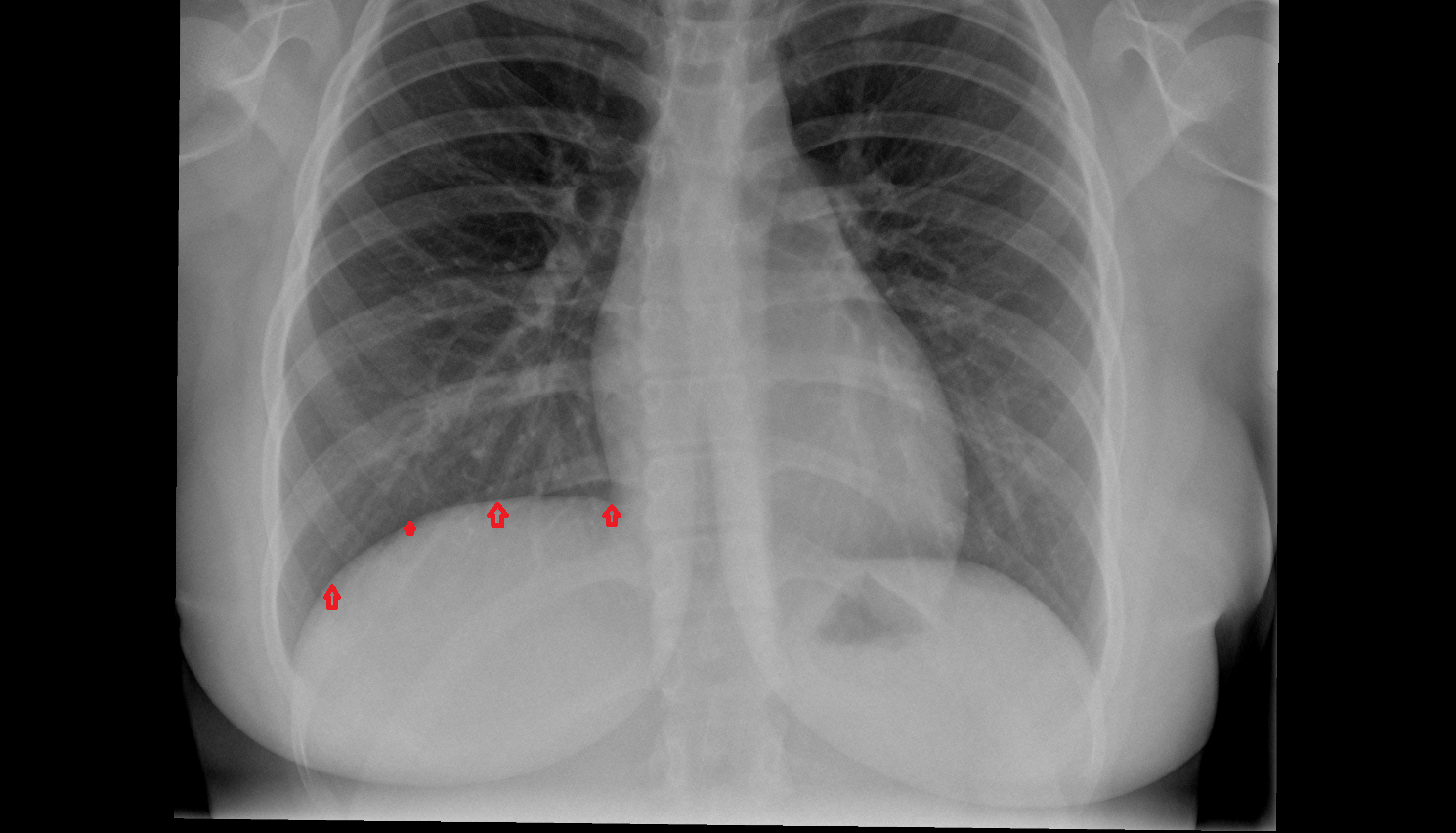 Right hemidiaphragm x ray Anatomy, Location and Imaging Appearance CT anatomy image -img-00000-00000