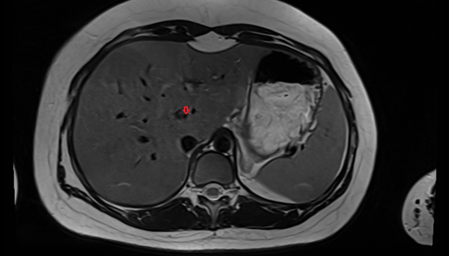 Right hepatic artery anatomy MRI axial   image -img-00000-00000