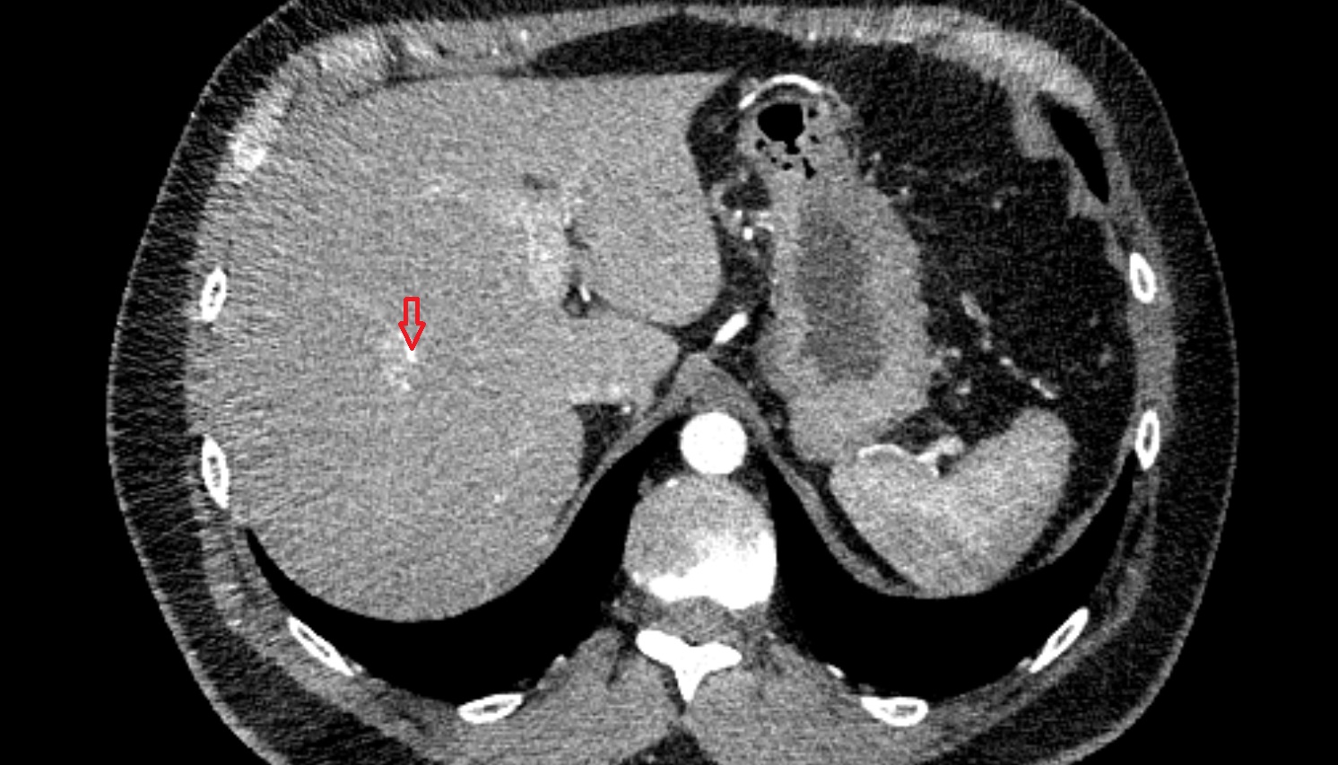 Right hepatic artery anatomy ct axial   image -img-00000-00000