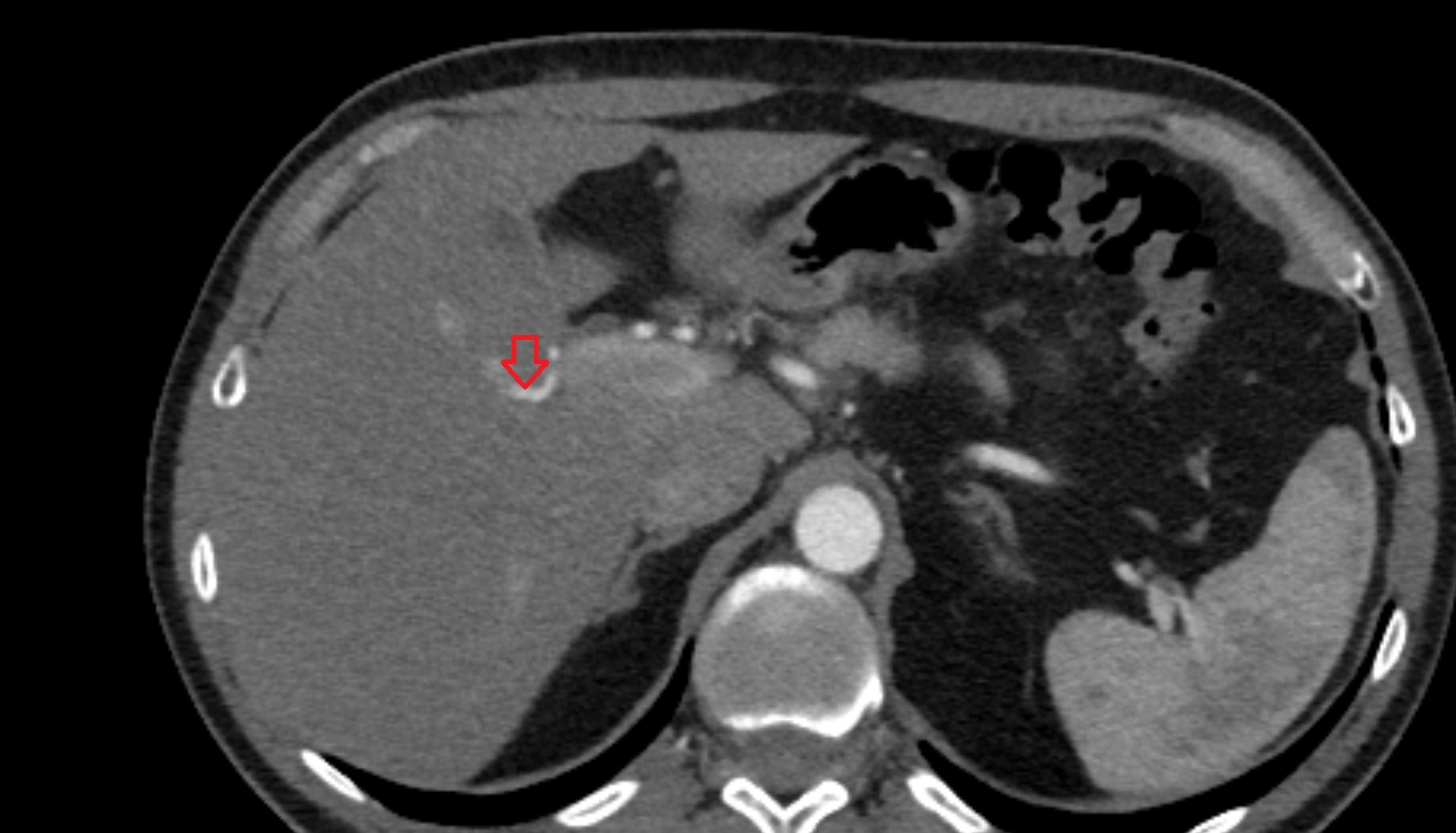Right hepatic artery anatomy ct axial   image -img-00000-00000_00001