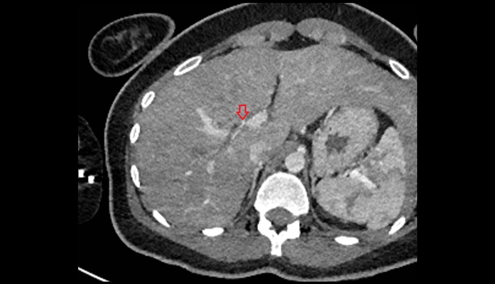 Right hepatic artery ct axial image