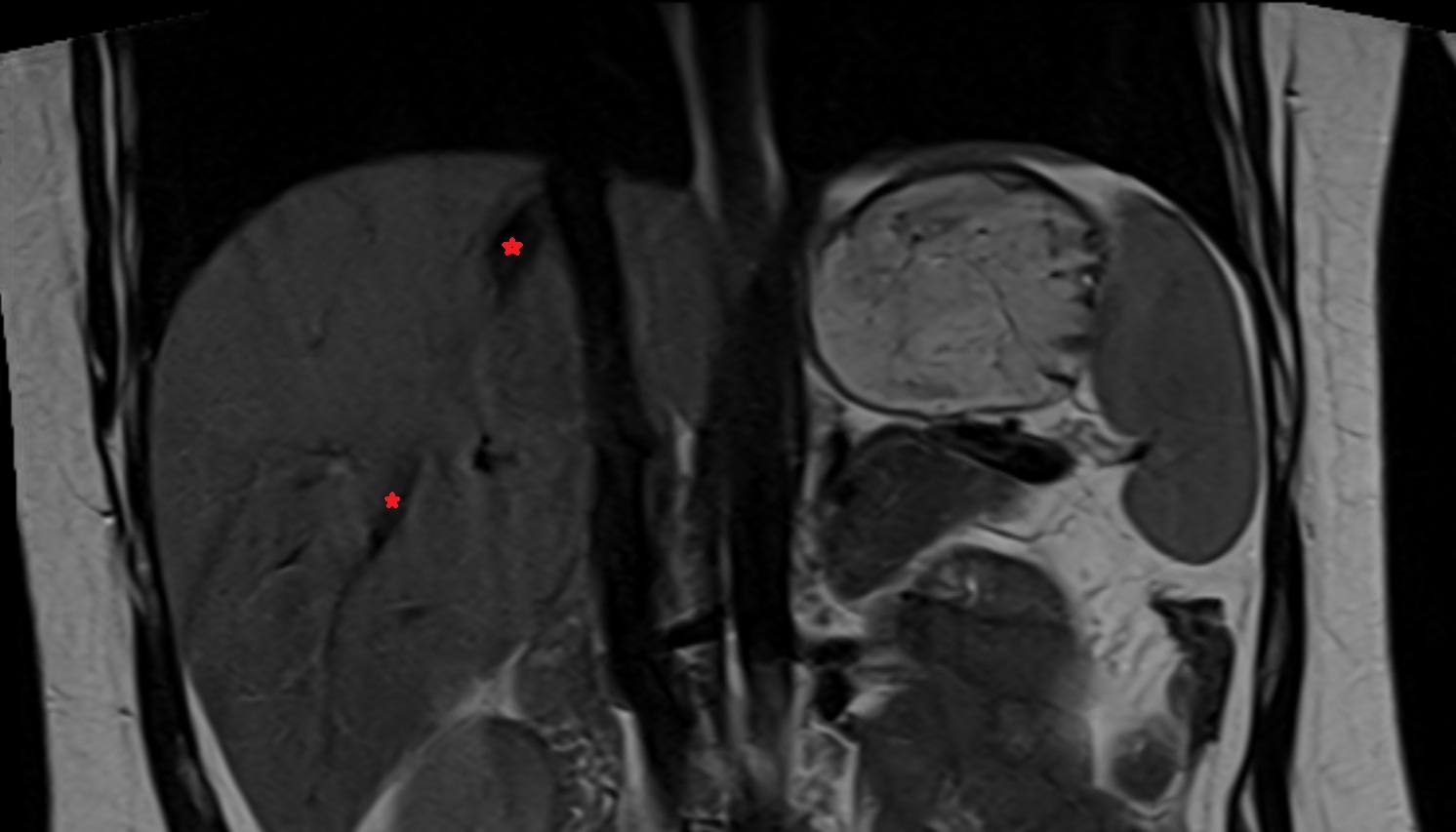 Right hepatic vein anatomy MRI coronal  image -img-00000-00000