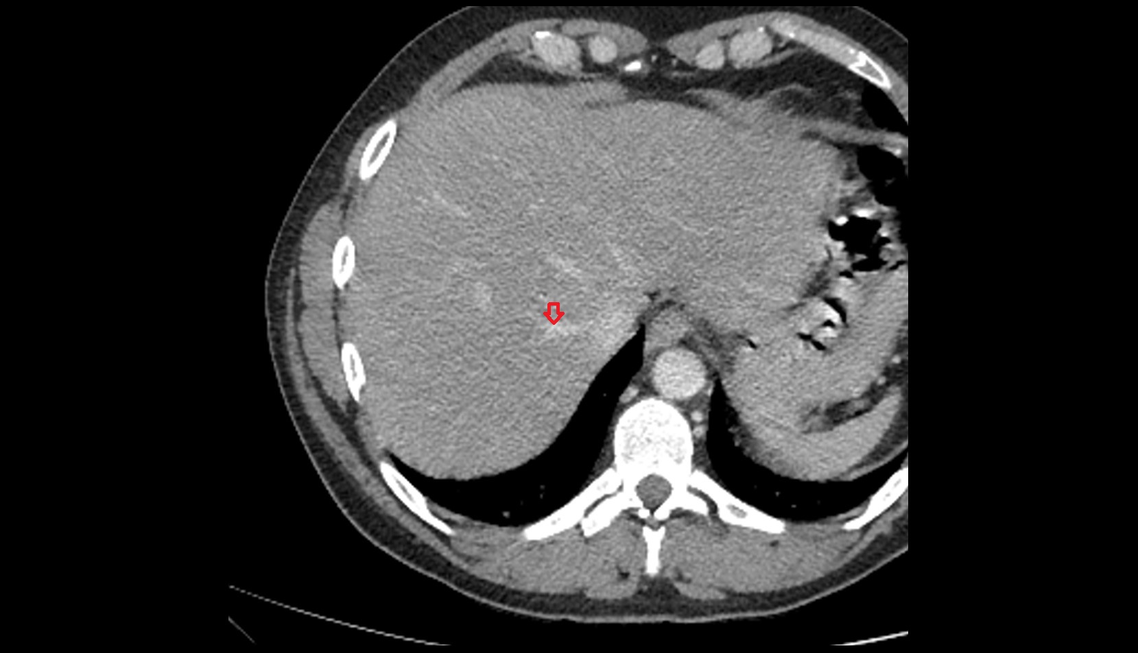 Right hepatic vein ct axial image