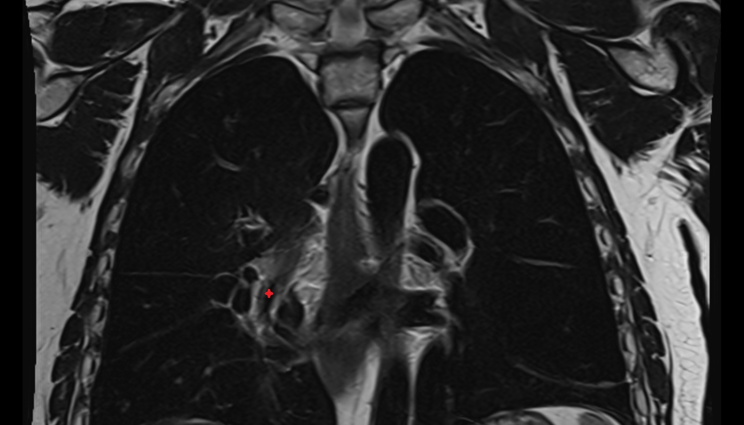 Right inferior lobar bronchus  anatomy MRI coronal  image -img-00000-00000