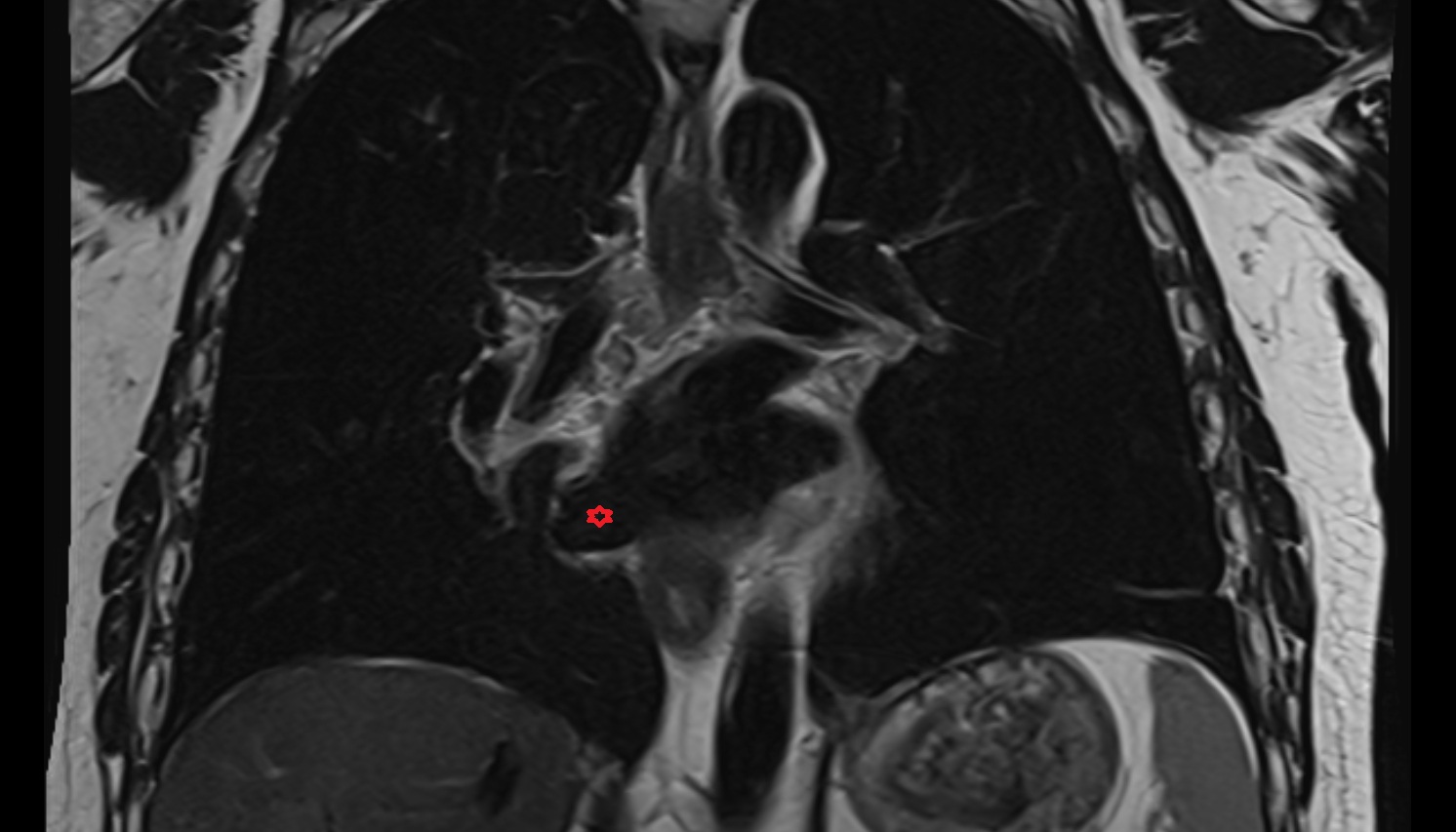 Right inferior pulmonary vein  anatomy MRI coronal  image -img-00000-00000