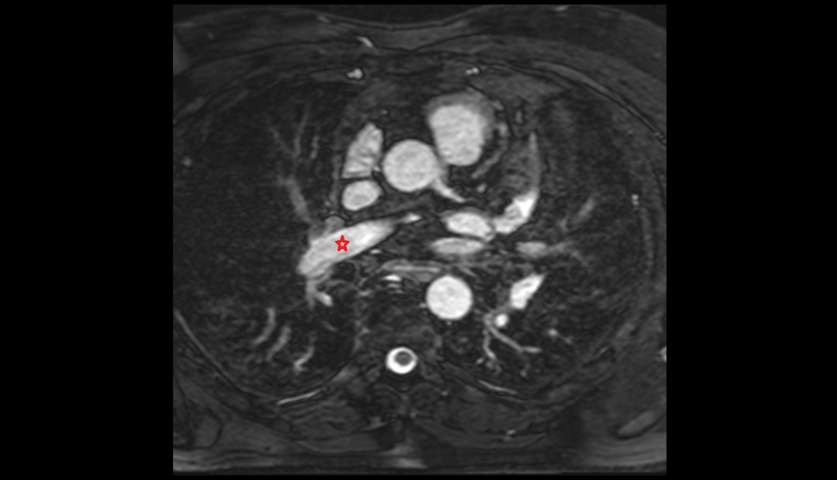 Right interlobar artery MRI IMAGE