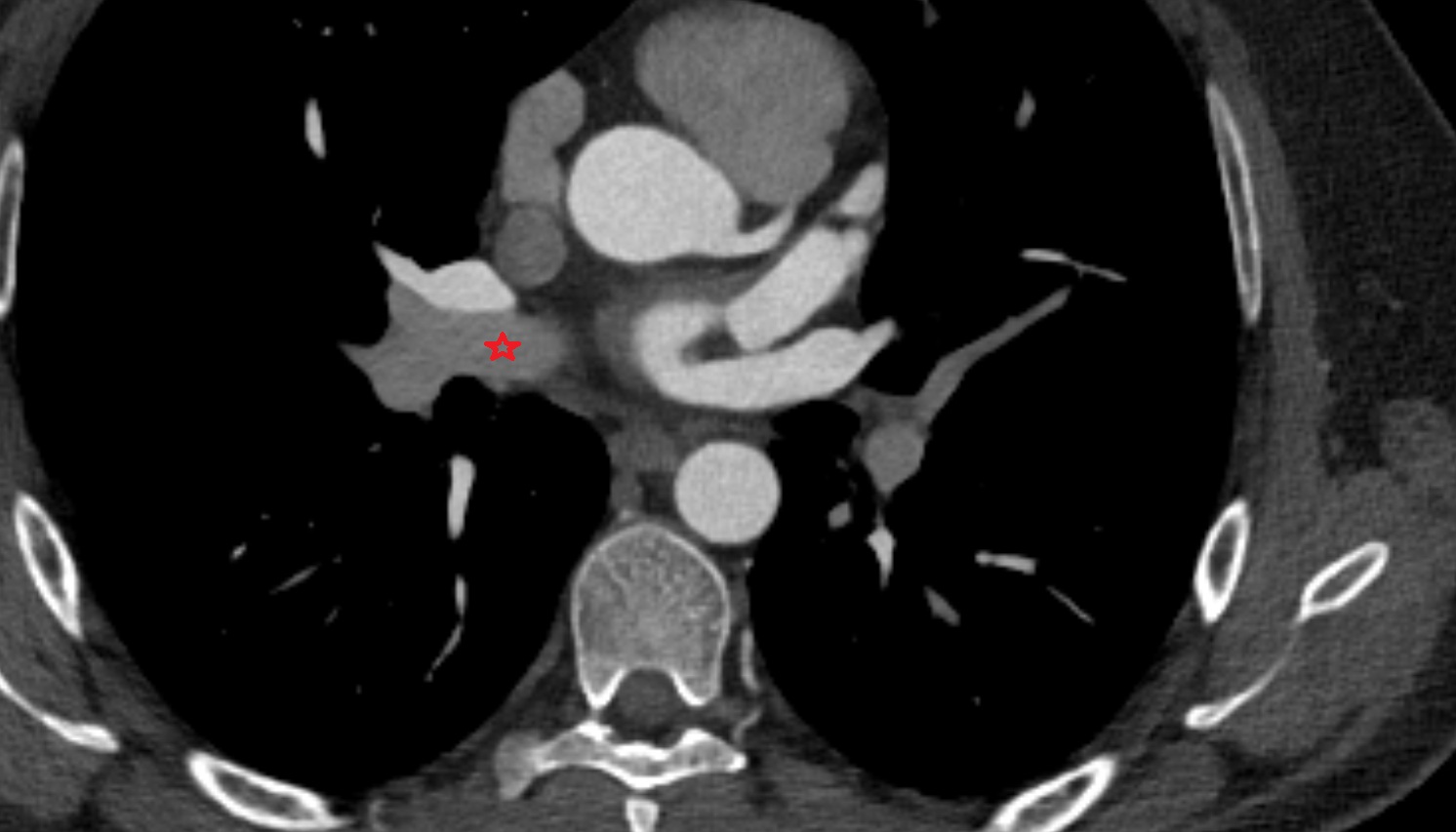 Right interlobar artery  anatomy CT axial  image -img-00000-00000