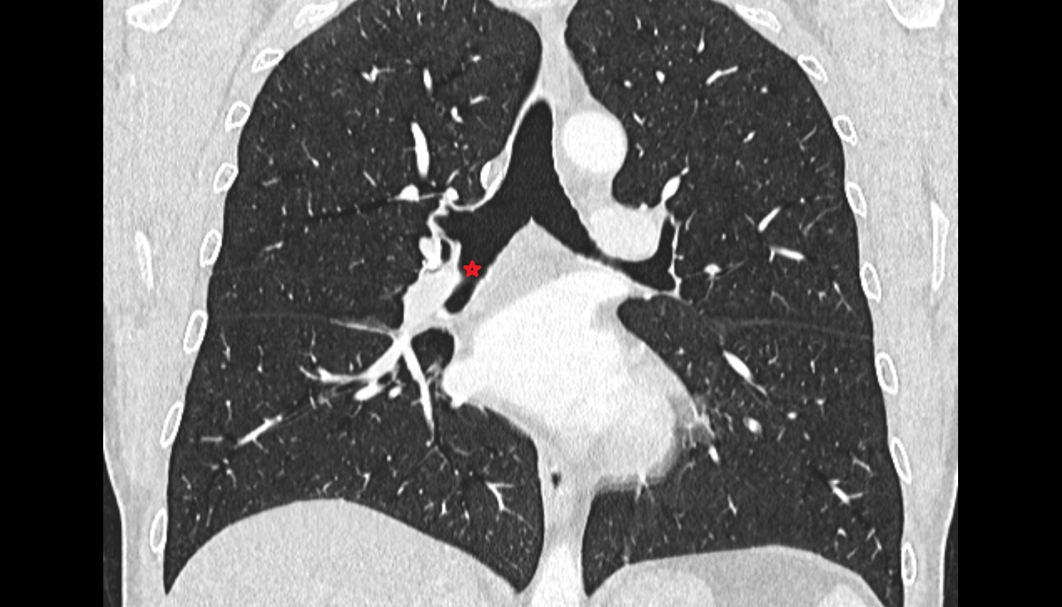 Right intermediate bronchus  anatomy  CT coronal  image -img-00000-00000