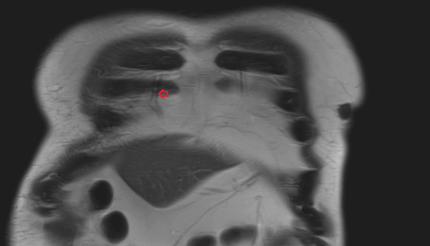 Right internal thoracic veins  MRI coronal  anatomy  image -img-00000-00000