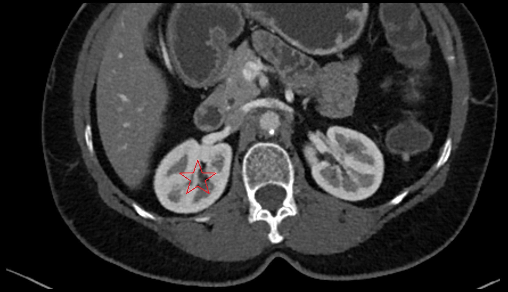 Right  kidney  CT axial image