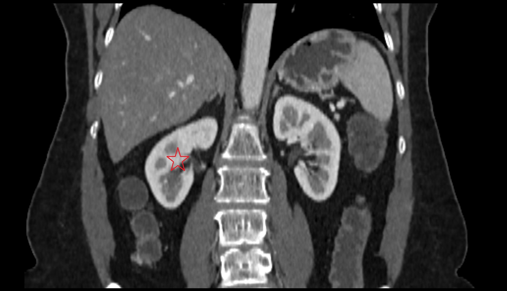 Right  kidney  CT coronal image