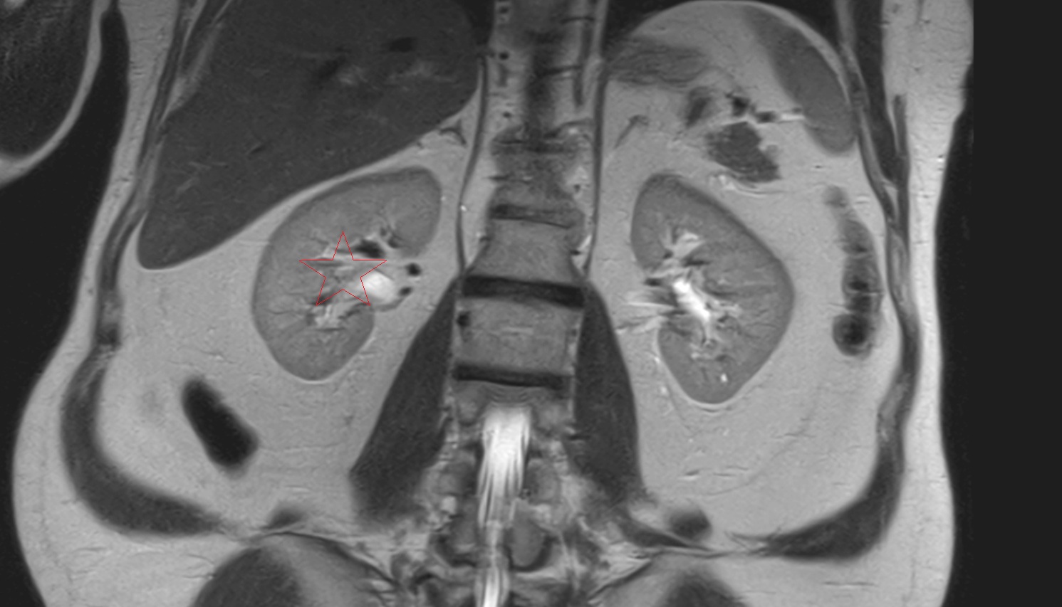 Right  kidney  MRI  coronal  image anatomy  image -img-00000-00000