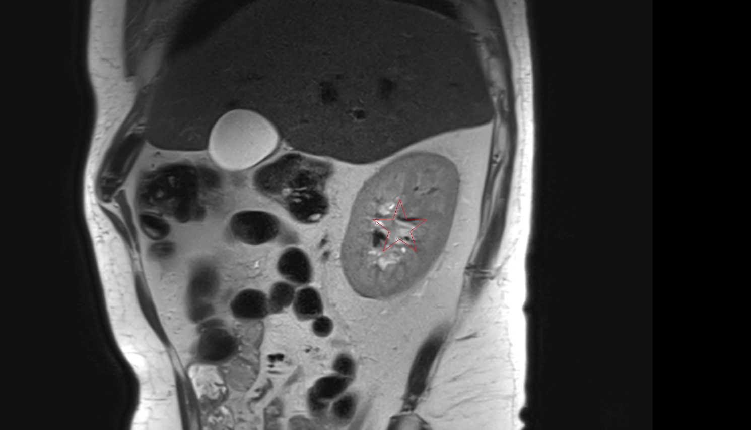 Right  kidney  MRI  sagittal  image anatomy  image -img-00000-00000