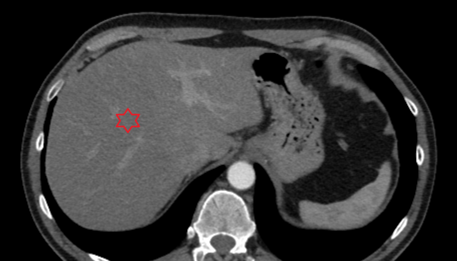 Right lobe of liver  CT axial  image -img-00000-00000