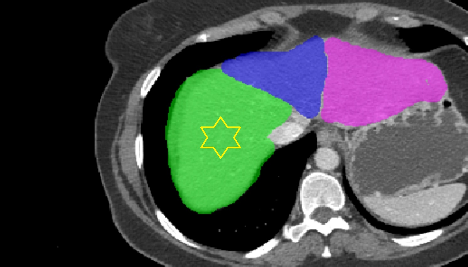 Right lobe of the liver  ct  axial  anatomy  image-img-00000-00000