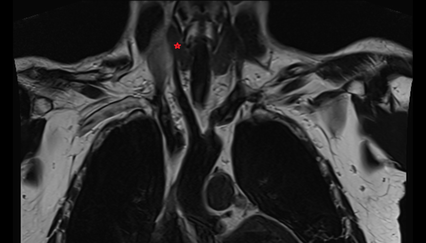 Right lobe of thyroid gland coronal MRI  image -img-00000-00000