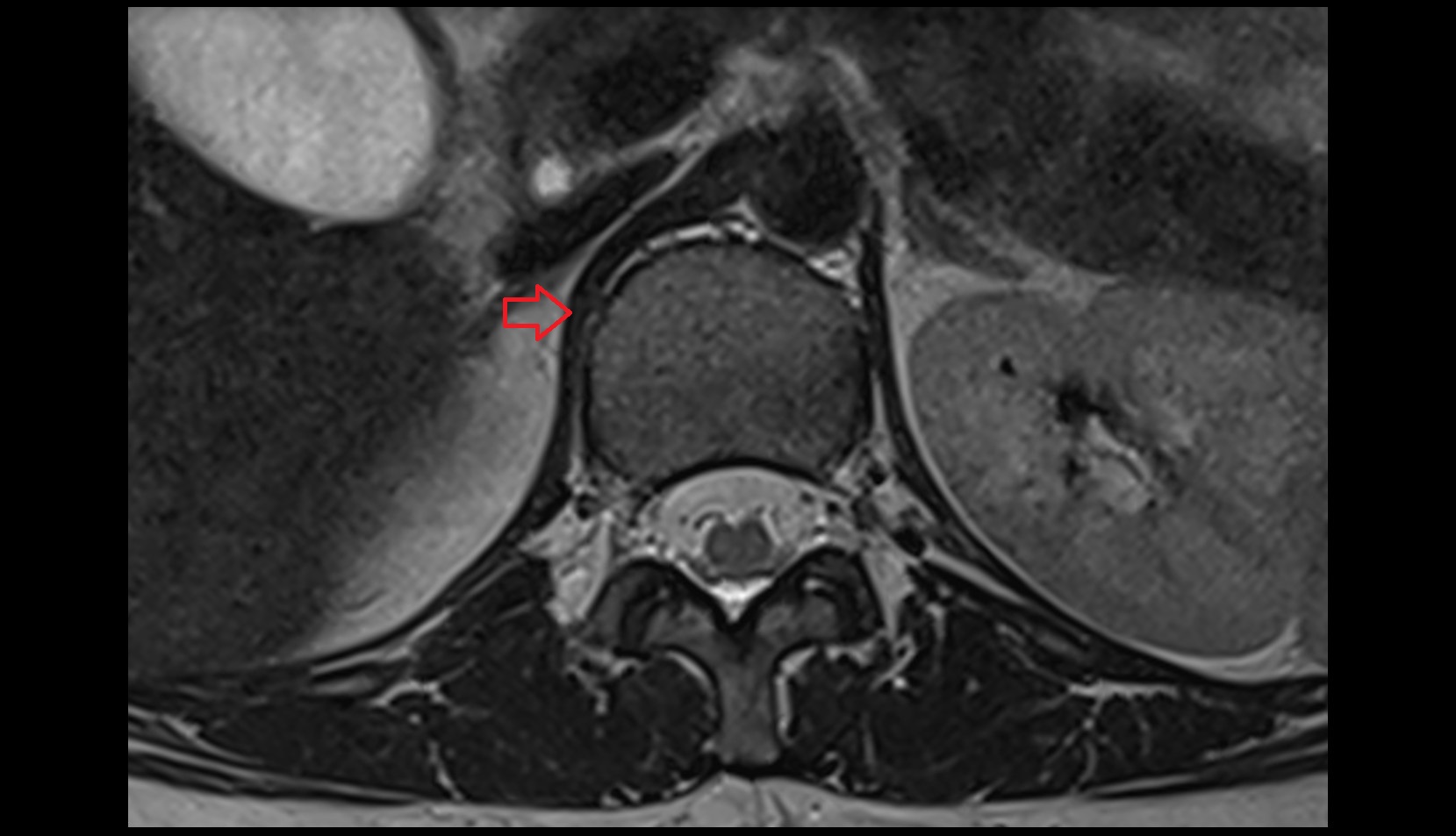 Right lumbar part of diaphragm axial