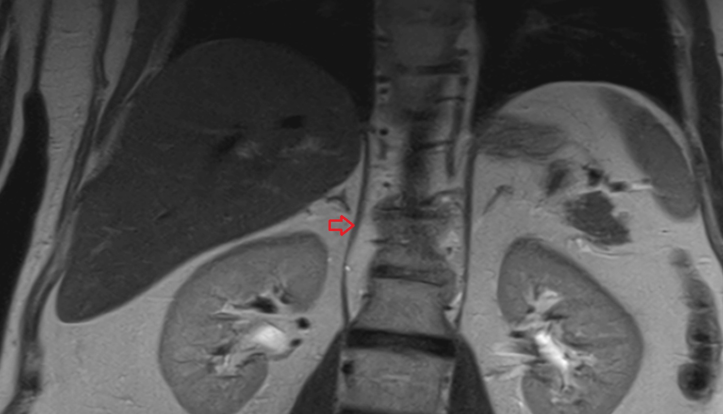 Right lumbar part of diaphragm  mri coronal   anatomy  image-img-00000-00000