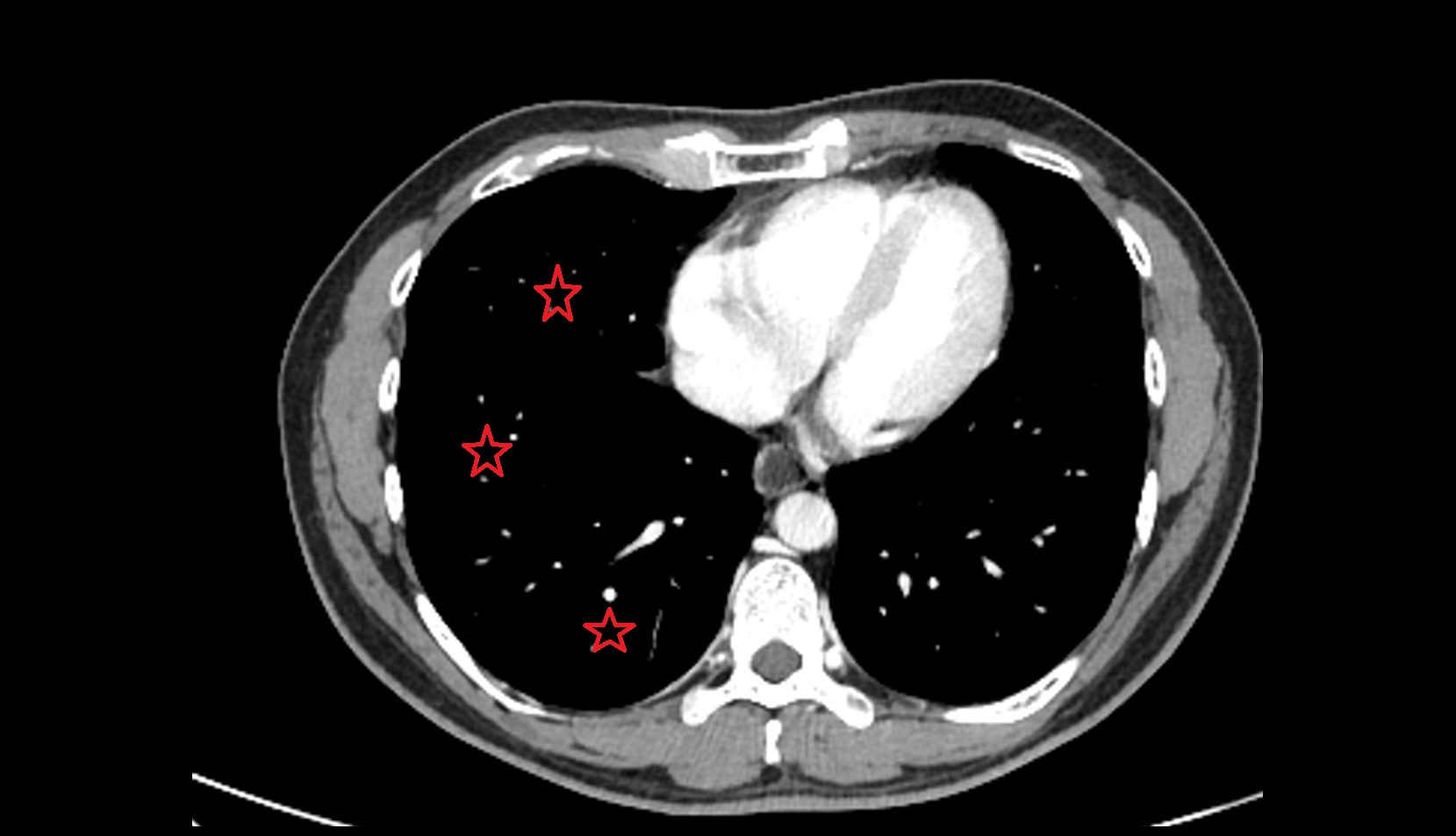 Right lung ct axial image