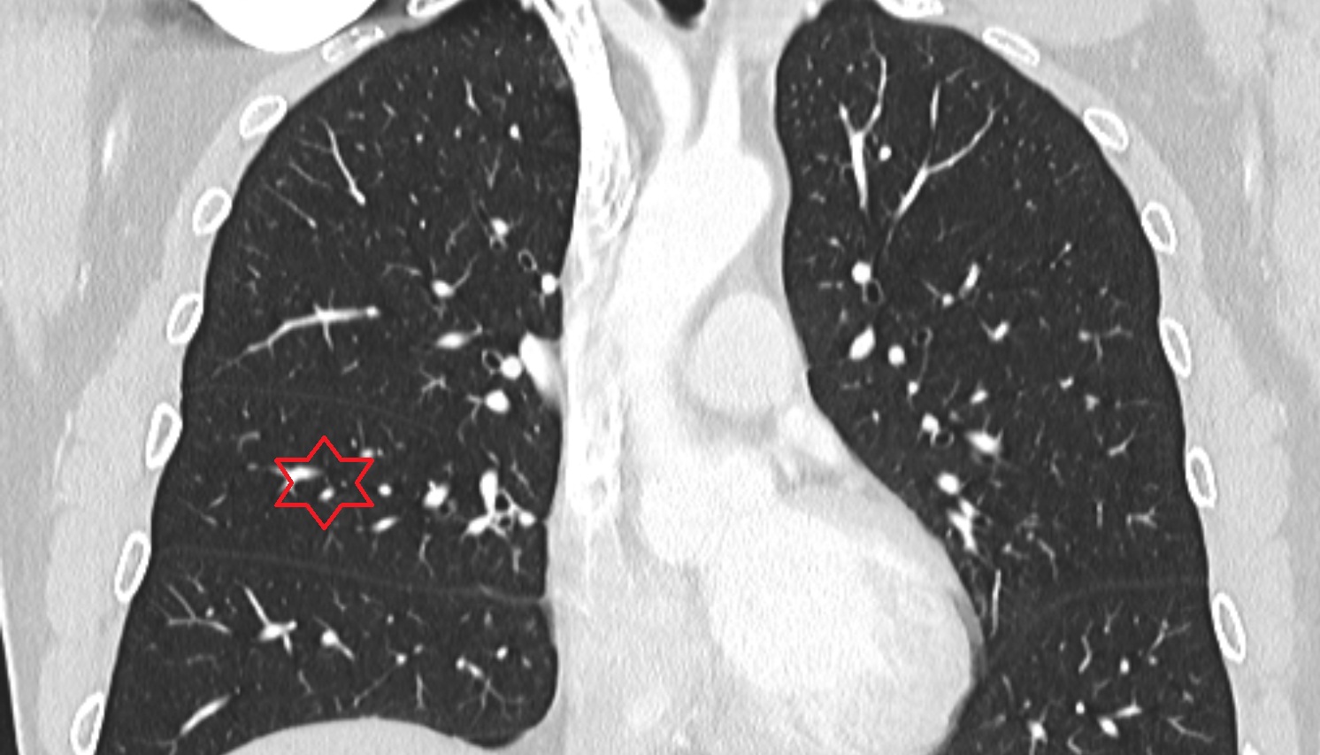 Right lung (middle lobe) anatomy  CT coronal  image -img-00000-00000