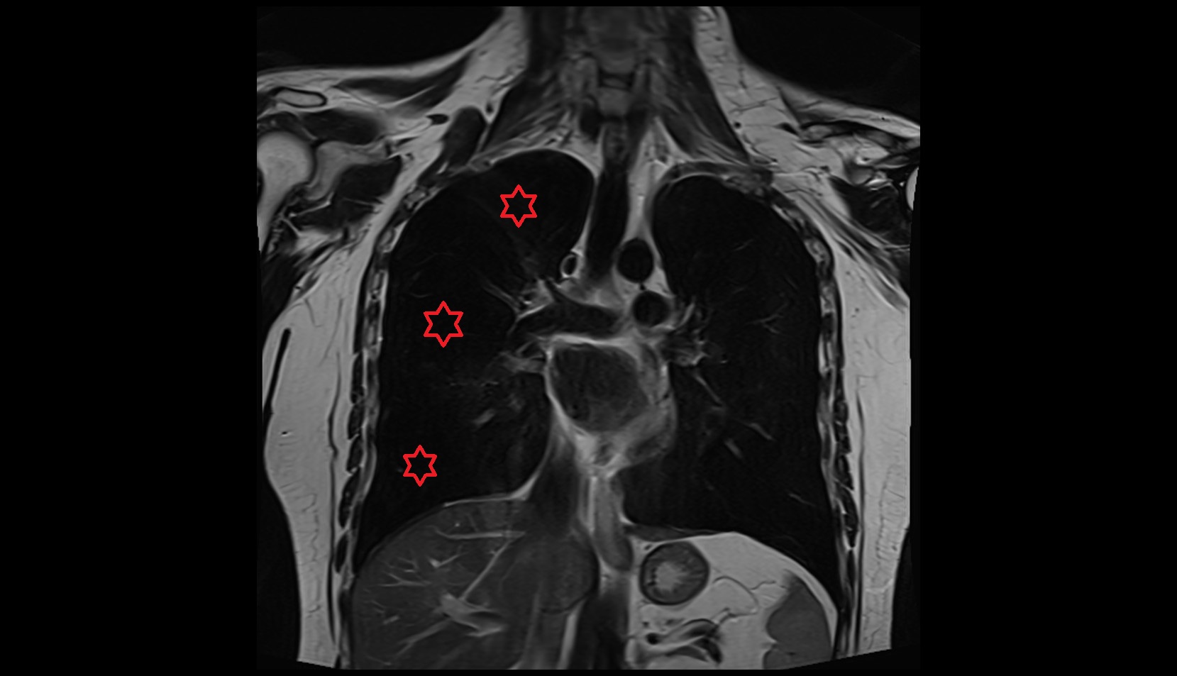 Right lung mri coronal image