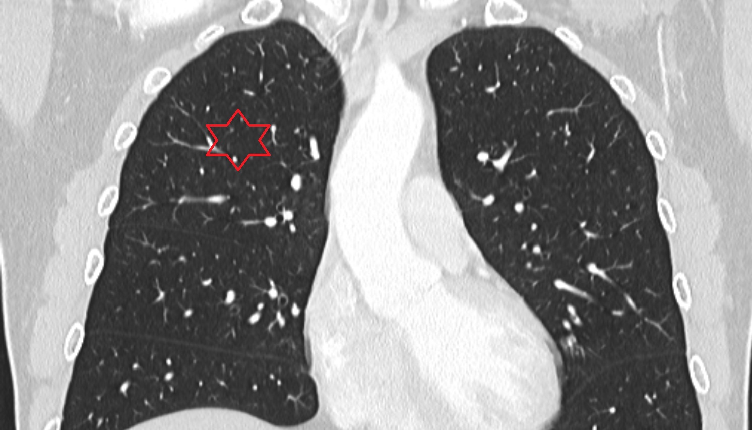 Right lung (superior lobe) anatomy  CT coronal  image -img-00000-00000