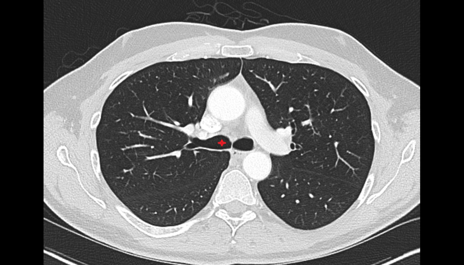 Right main bronchus  anatomy CT axial  image -img-00000-00000