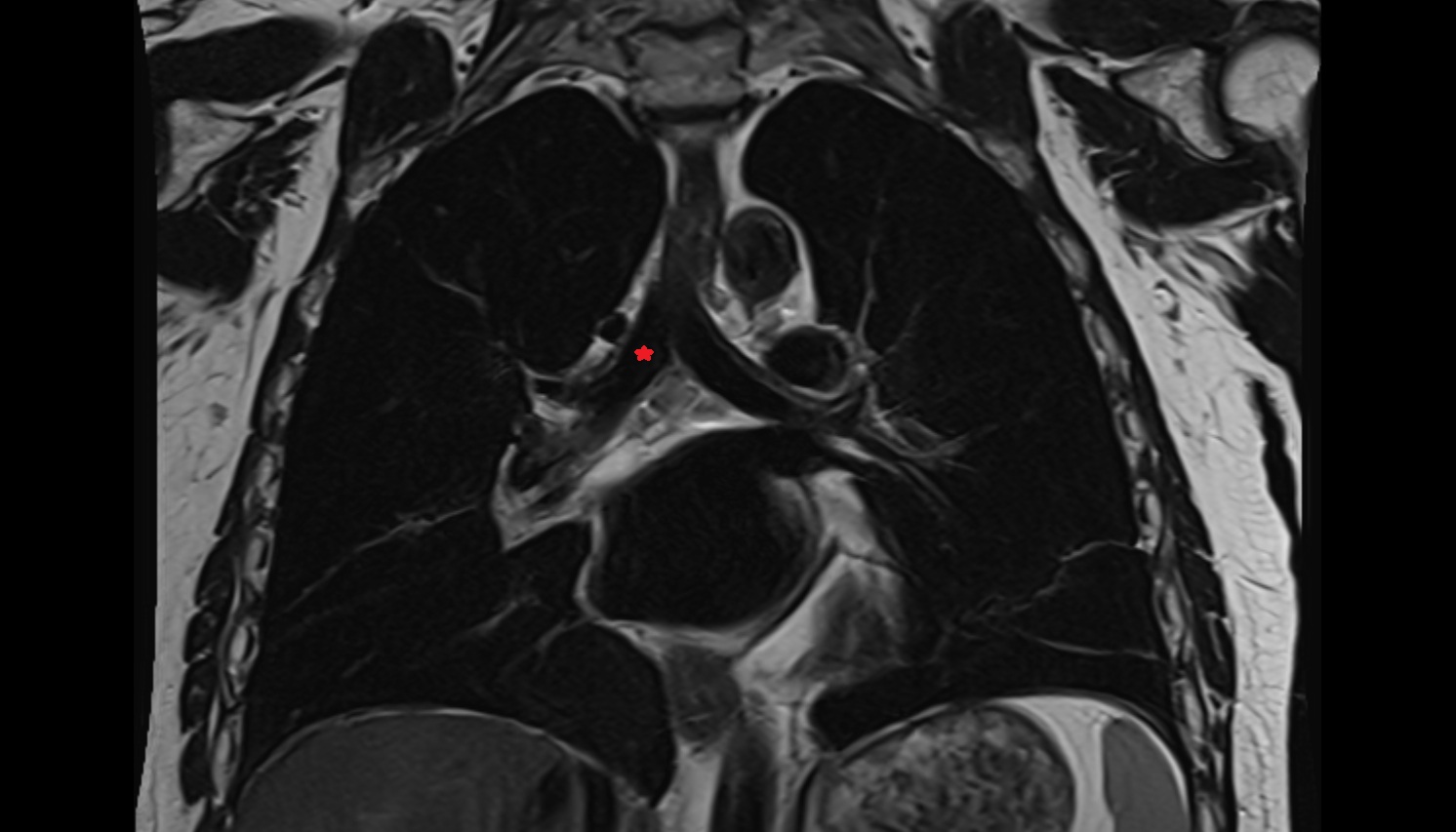 Right main bronchus  anatomy  mri coronal image -img-00000-00000