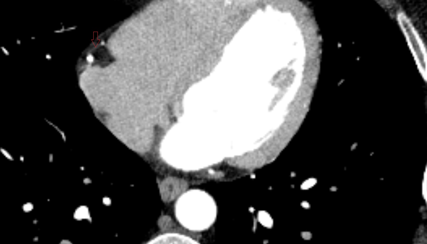 Right marginal vein of heart  CT  axial image -img-00000-00000