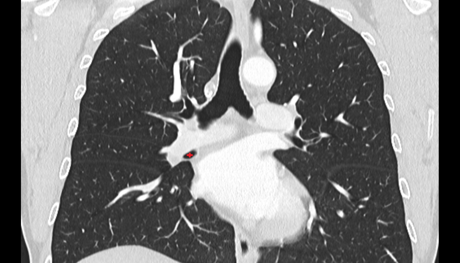 Right middle lobar bronchus CT IMAGE