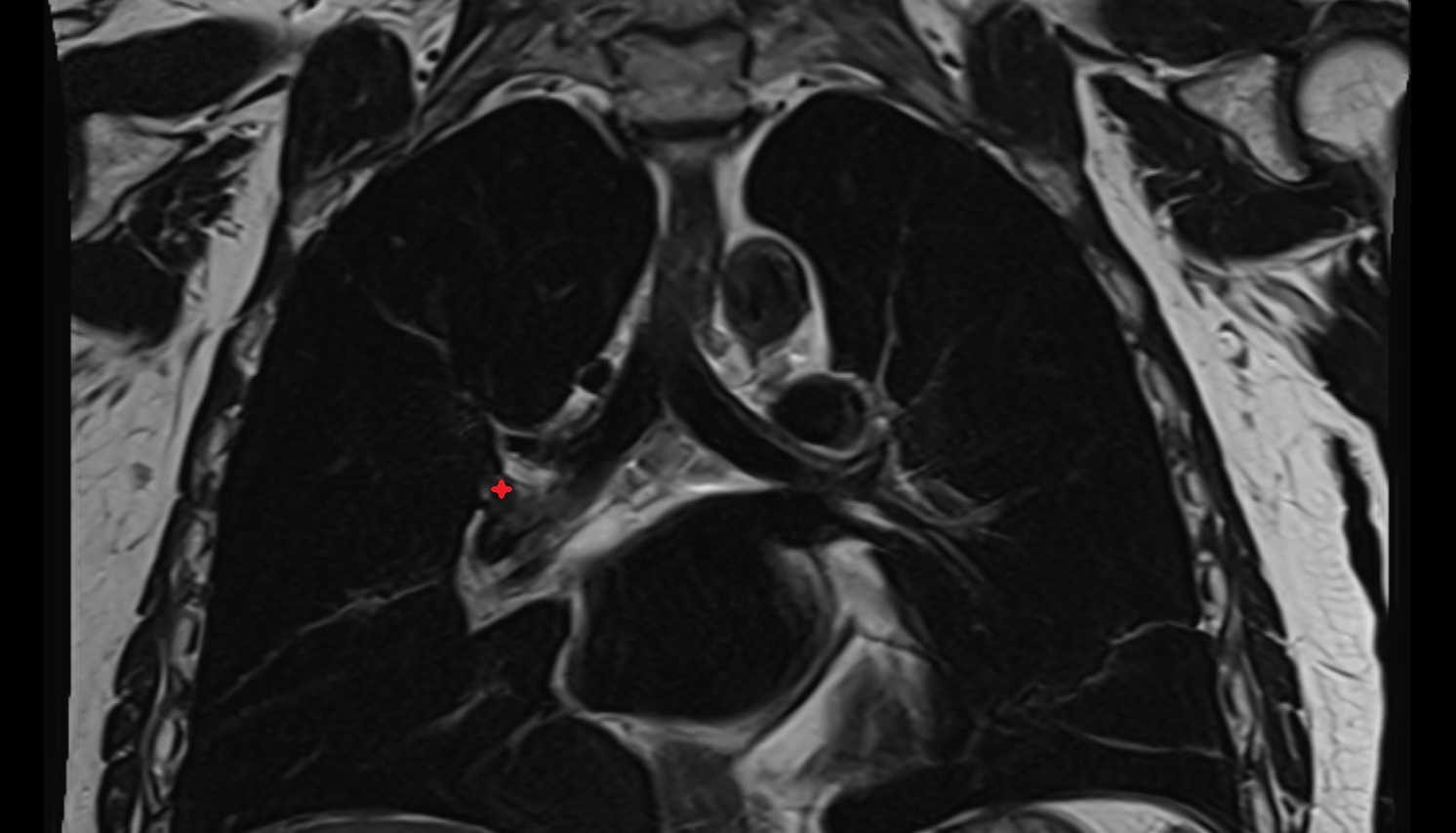 Right middle lobar bronchus  anatomy MRI coronal  image -img-00000-00000