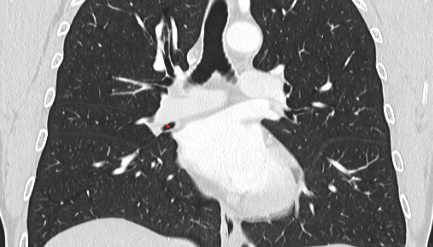 Right middle lobe bronchus  anatomy  CT coronal  image -img-00000-00000