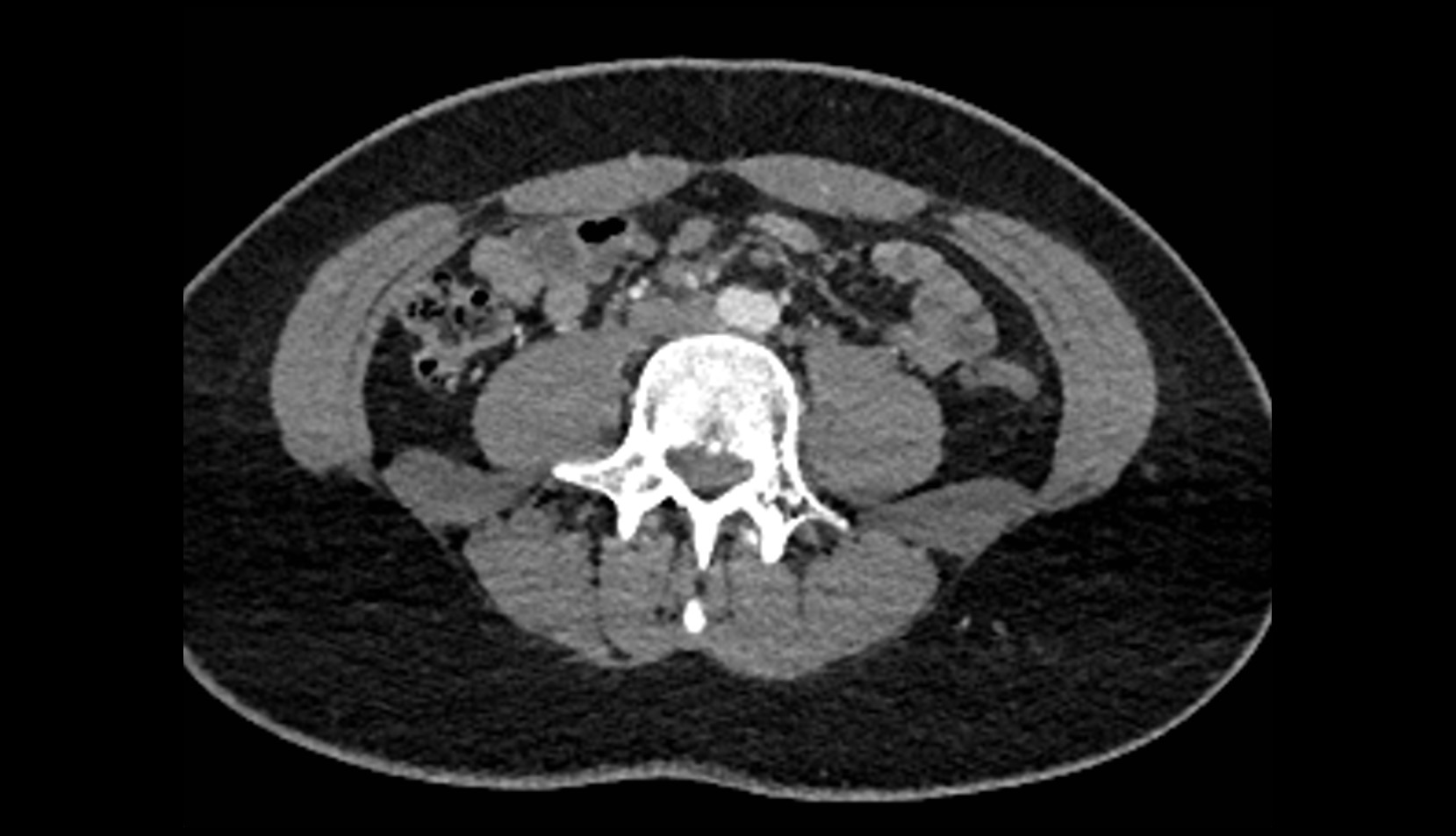 Right ovarian vein CT axial image