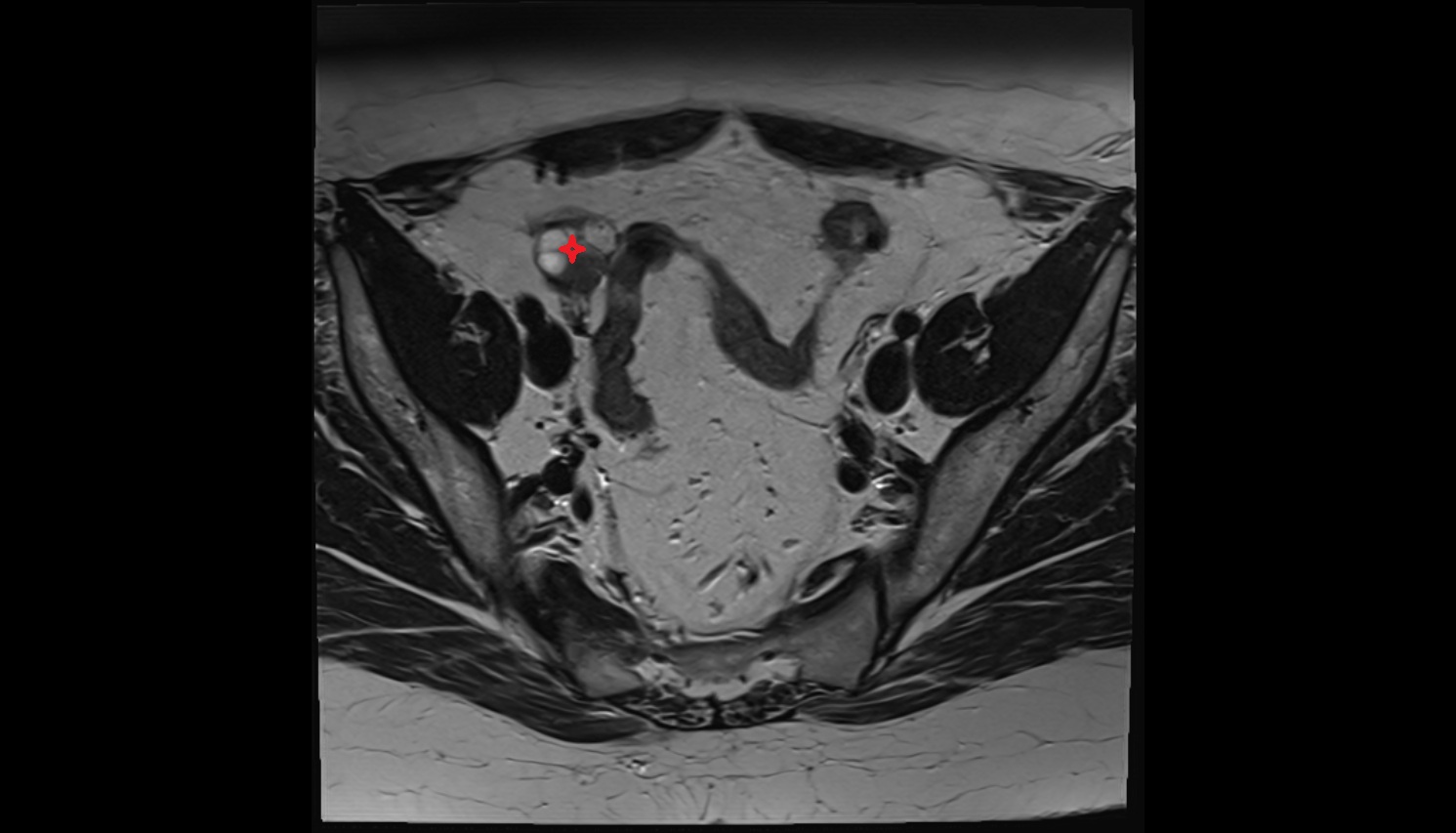 Right  ovary MRI  axial  image anatomy  image-img-00000-00000