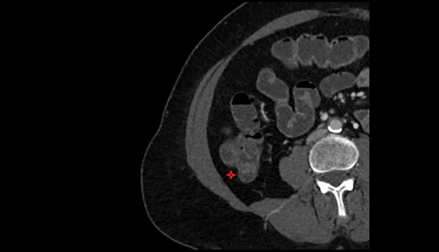 Right paracolic gutter CT axial image