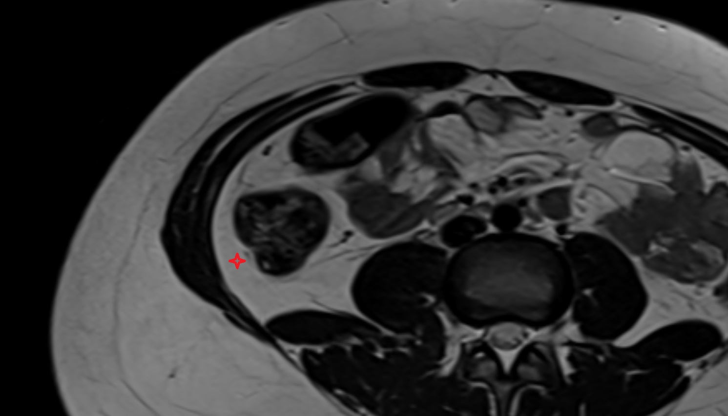 Right paracolic gutter    MRI  axial image anatomy  image -img-00000-00000