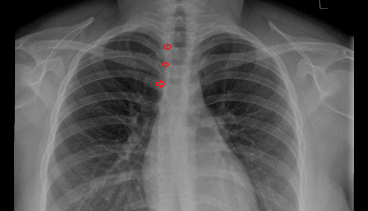 Right paratracheal stripe x ray  Anatomy, Location and Imaging Appearance CT anatomy image -img-00000-00000