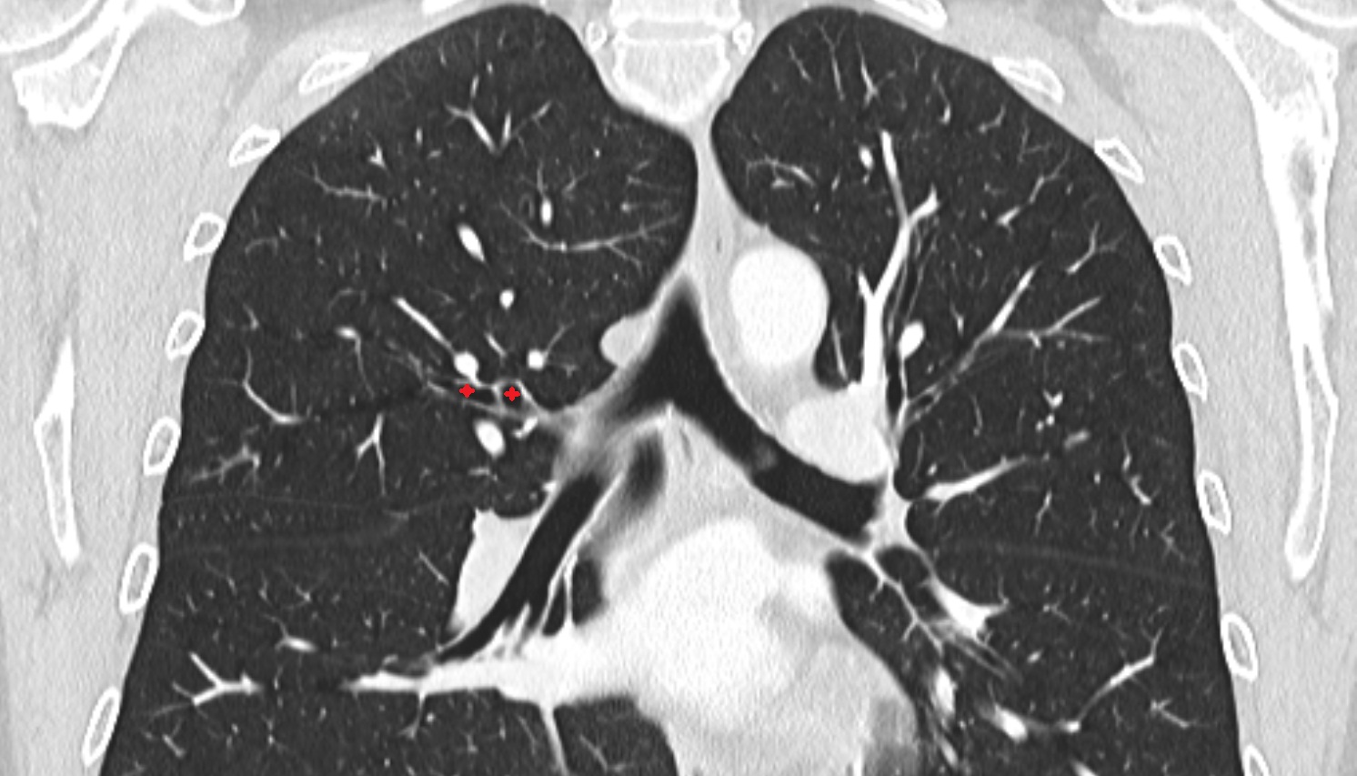 Right posterior segmental bronchus (B2, B2a, B2b)  anatomy  CT coronal  image -img-00000-00000