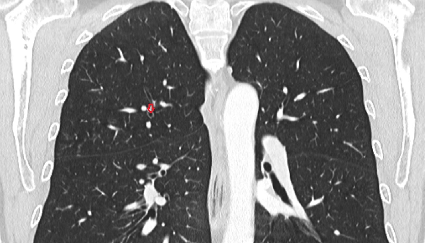 Right posterior segmental bronchus (B2, B2a, B2b)  anatomy  CT coronal  image -img-00000-00000_00001