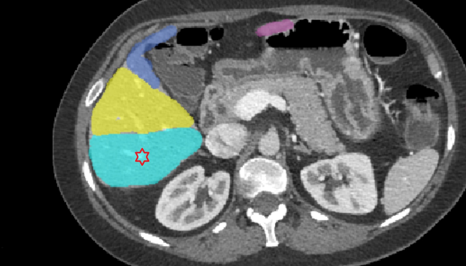 Liver right  posteroinferior segment — Segment VI   CT  axial  anatomy  image
