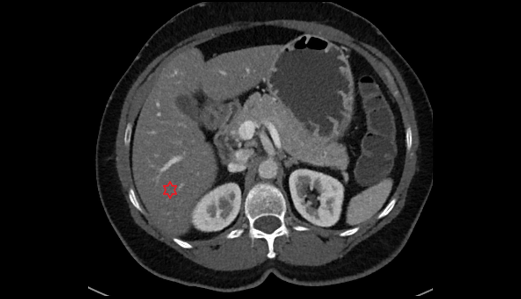 Liver right posteroinferior segment — Segment VI CT axial image