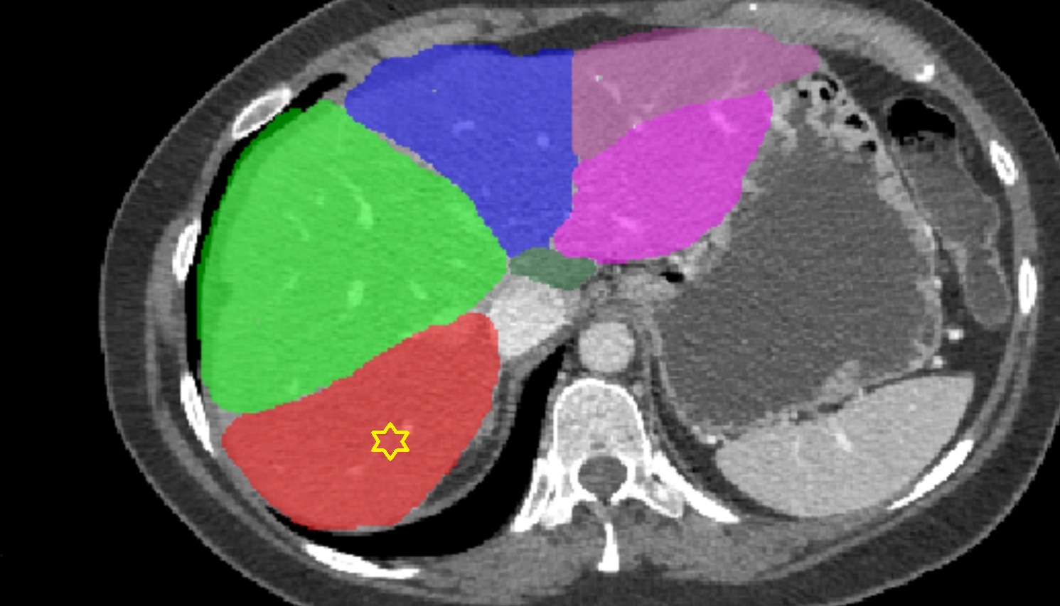 Liver right posterosuperior segment — Segment VII   CT  axial  anatomy  image