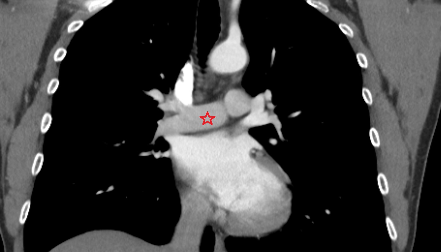Right pulmonary artery  anatomy CT coronal  image -img-00000-00000