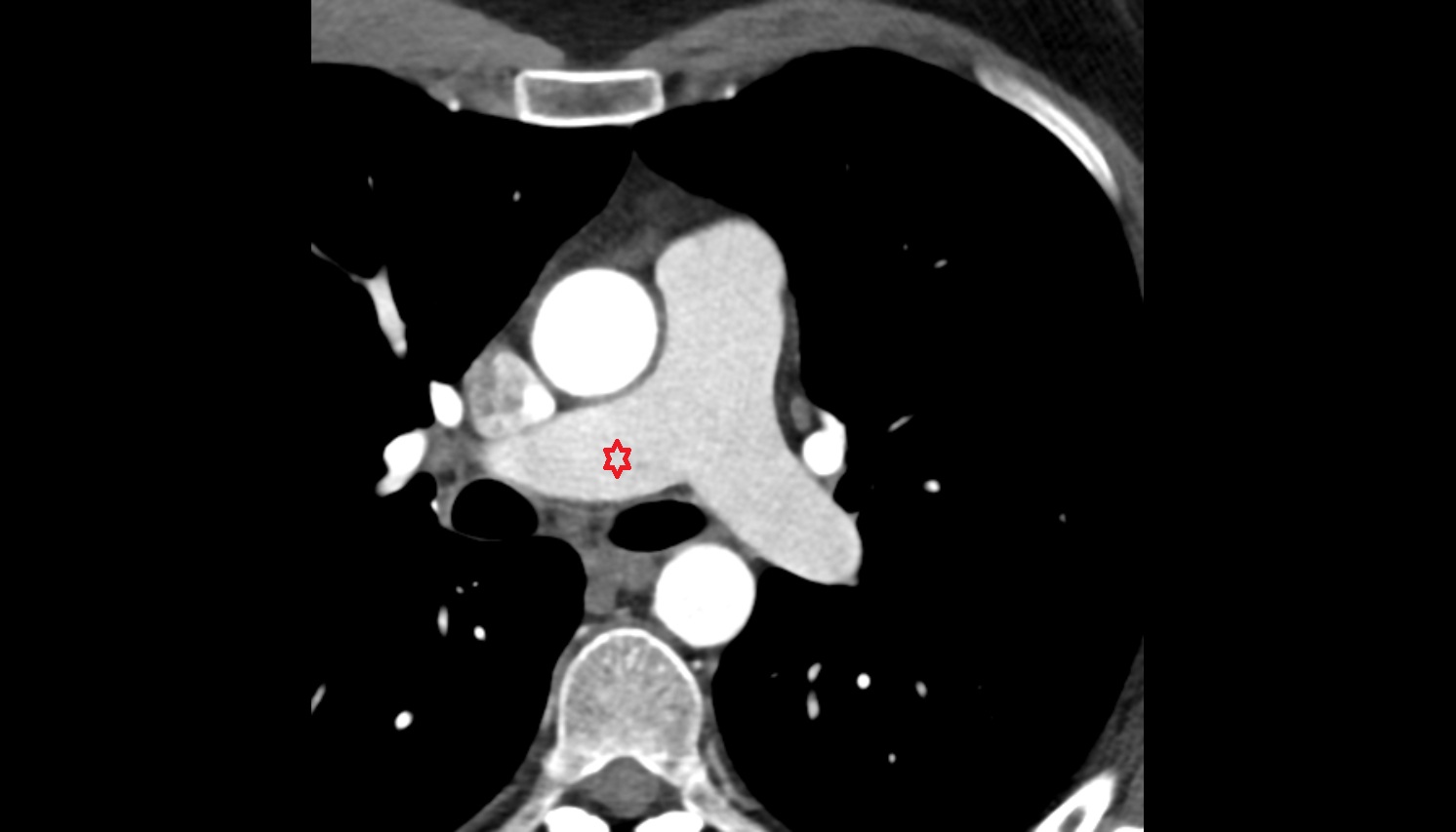 Right pulmonary artery  anatomyct axial  image -img-00000-00000
