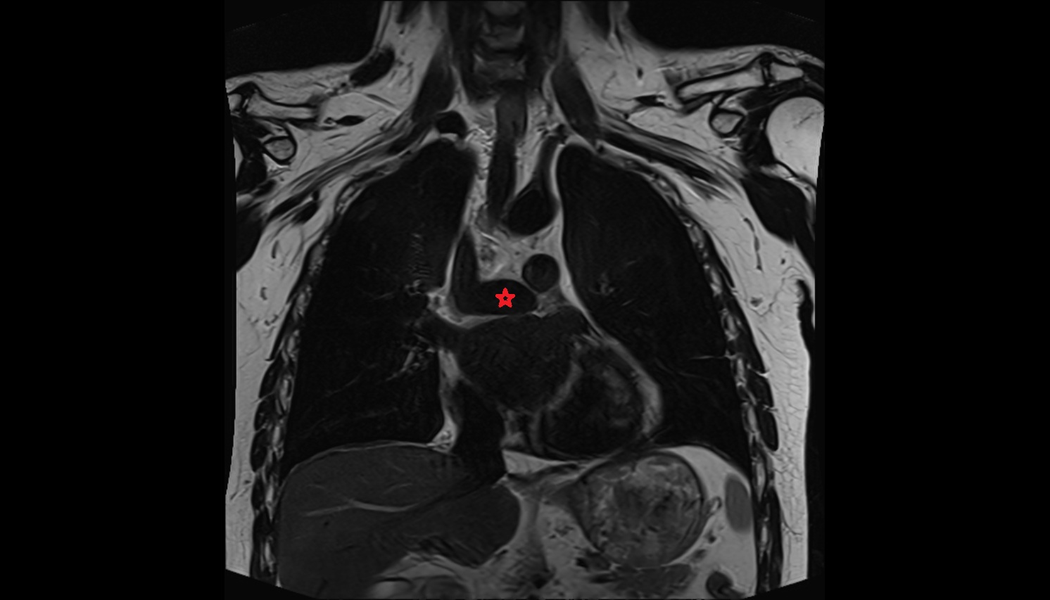 Right pulmonary artery  anatomy mri coronal  image -img-00000-00000