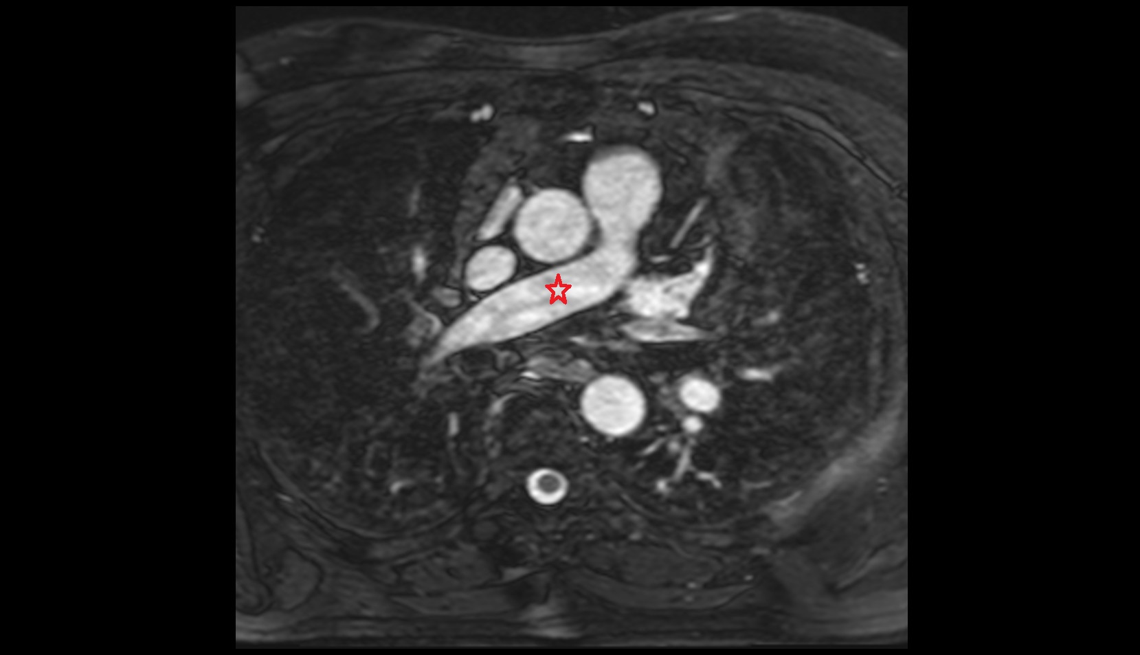 Right pulmonary artery mri image
