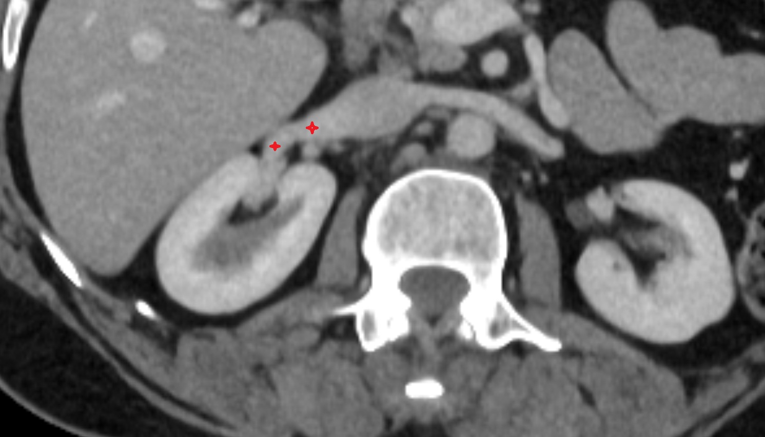 Right renal vein  CT AXIAL image anatomy  image -img-00000-00000