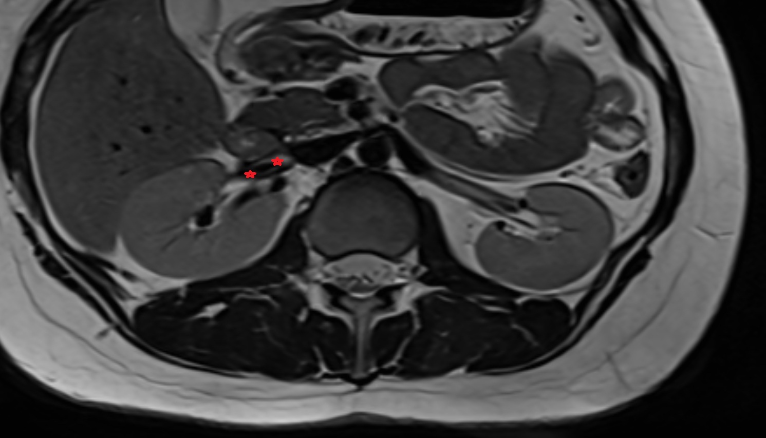 Right renal vein MRI AXIAL image anatomy  image -img-00000-00000