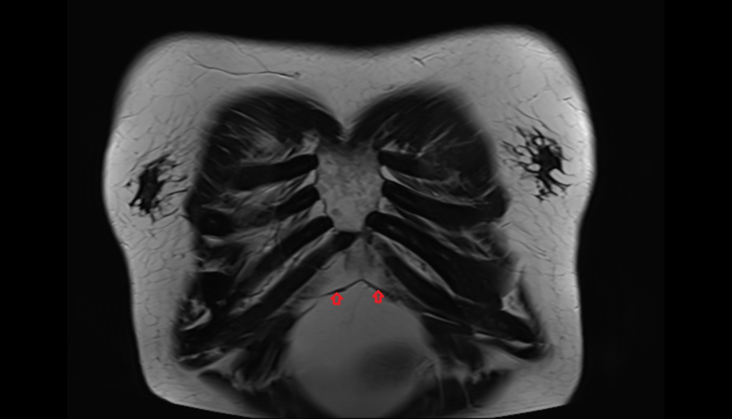 Right sternal part of diaphragm MRI coronal  image -img-00000-00000